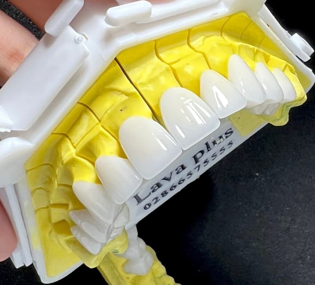 Phục hình implant 1