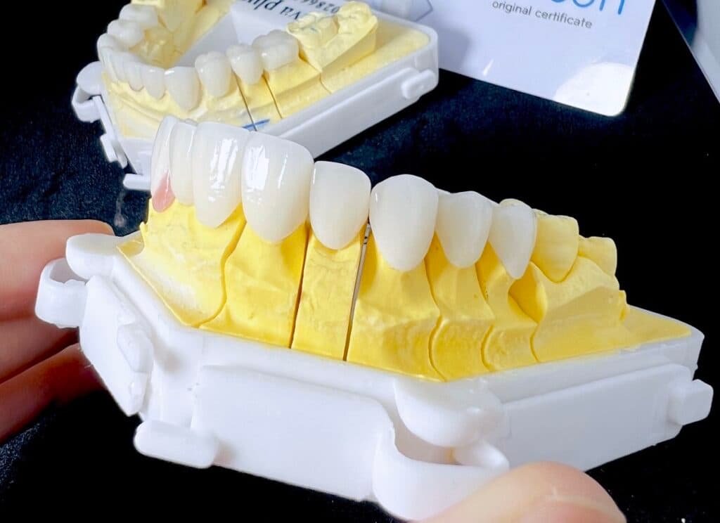 Phục hình implant 2