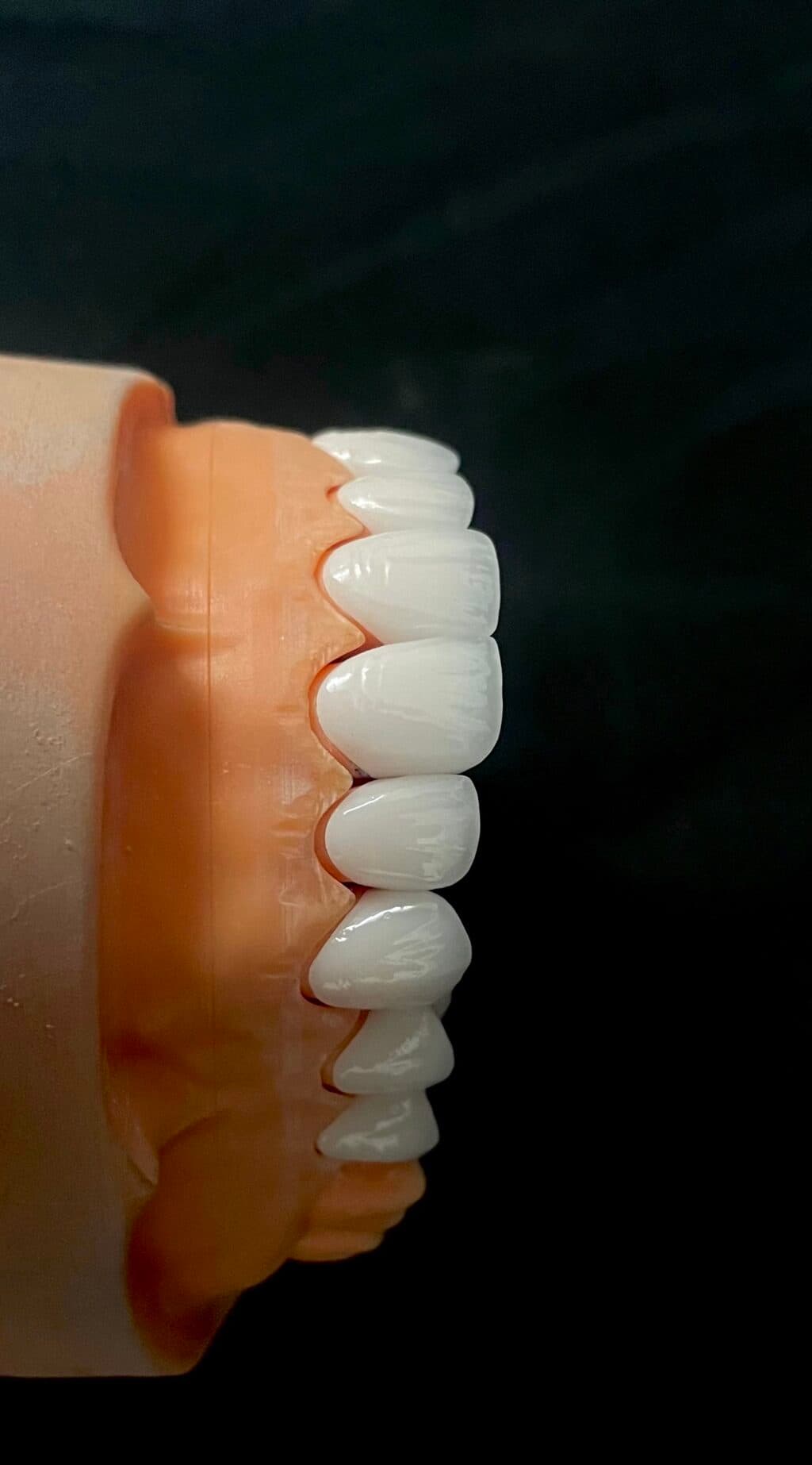 Phục hình implant 3